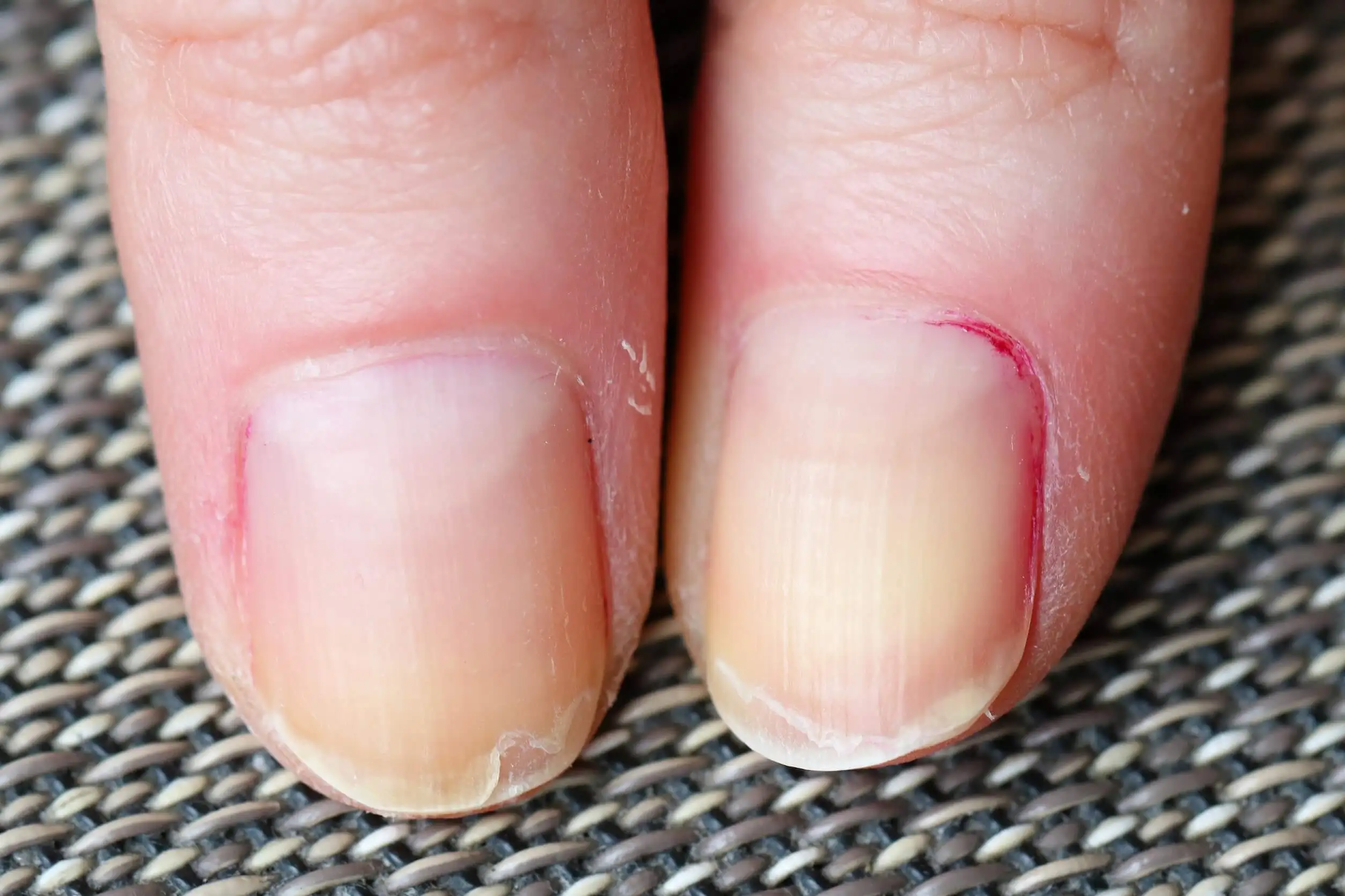 Les ongles peuvent avoir des problèmes à l'œil nu