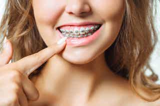 Extracción de molares: ¿es necesaria antes de la ortodoncia?