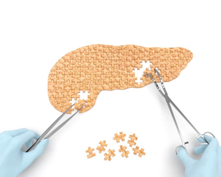Quistes pancreáticos: causas, síntomas y tratamiento