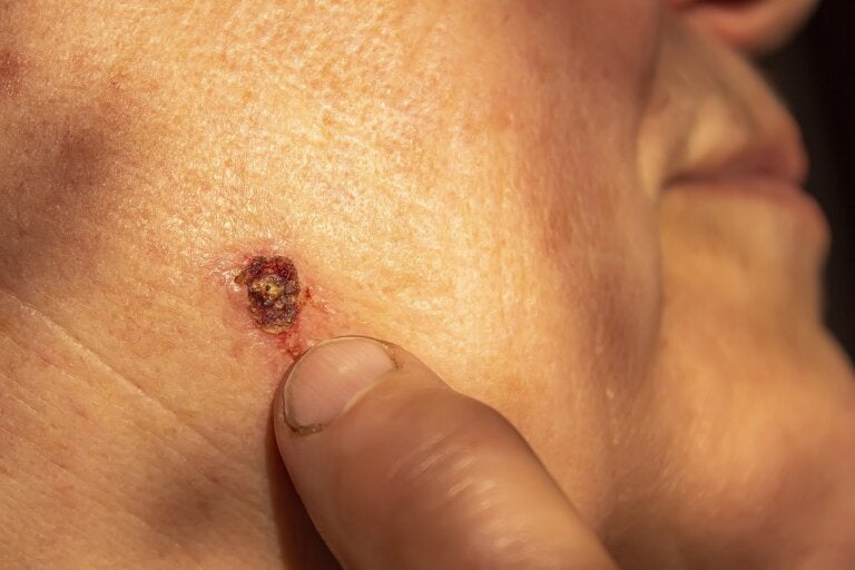 Carcinoma de células basales: el cáncer de piel más frecuente