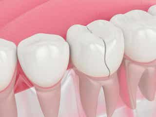 Fisura dental: cómo actuar y tratarla correctamente