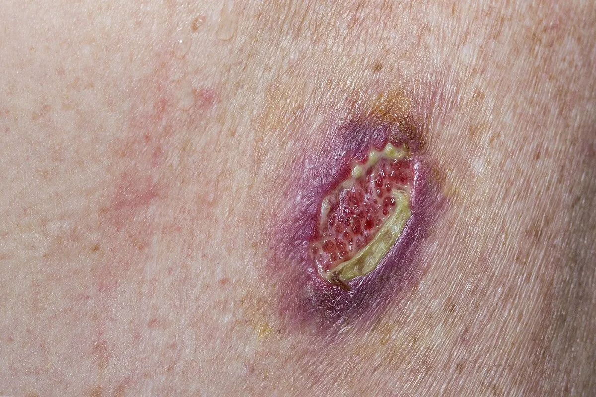 Síntomas comunes del carcinoma de células basales