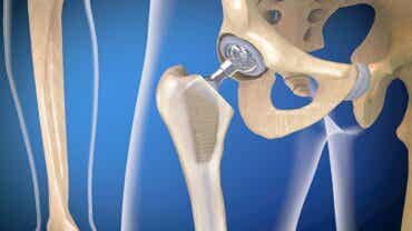 Infección de prótesis articulares: ¿por qué ocurre?