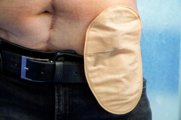Consejos para el día a día después de una ostomía