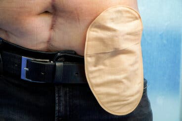 Consejos para el día a día después de una ostomía