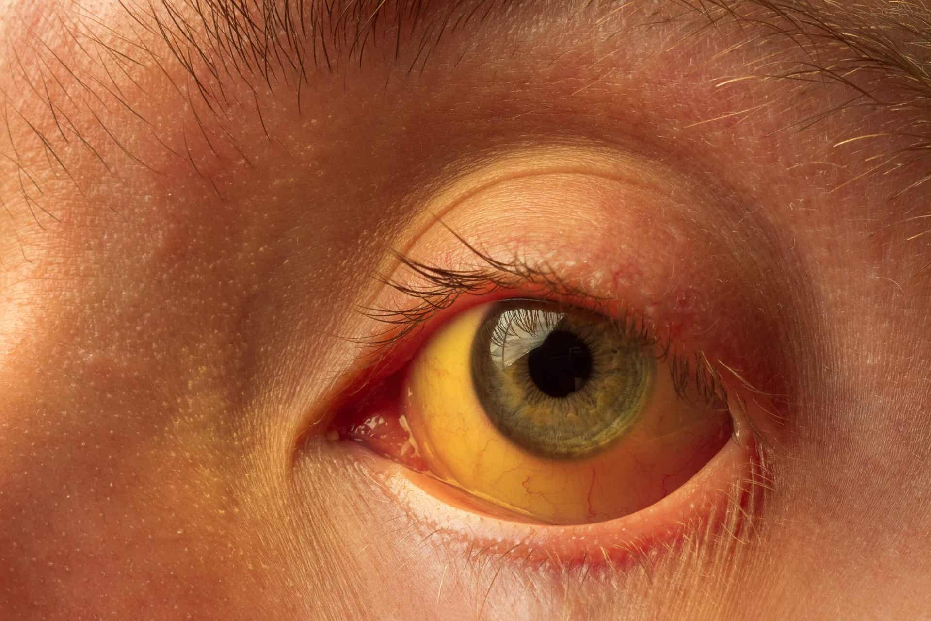 GGT-Test - Nahaufnahme eines gelb gefärbten Auges