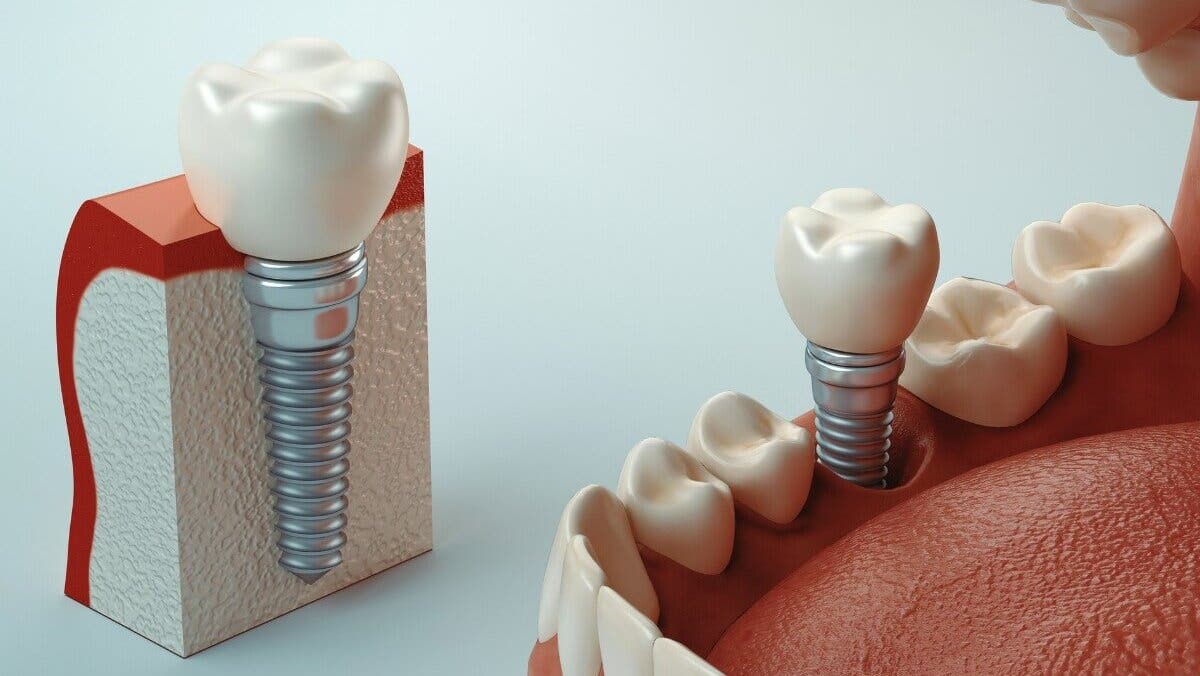 Implante dental.
