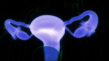 Quistes dermoides ováricos: síntomas y cuándo consultar al médico