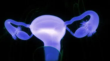 Quistes dermoides ováricos: síntomas y cuándo consultar al médico