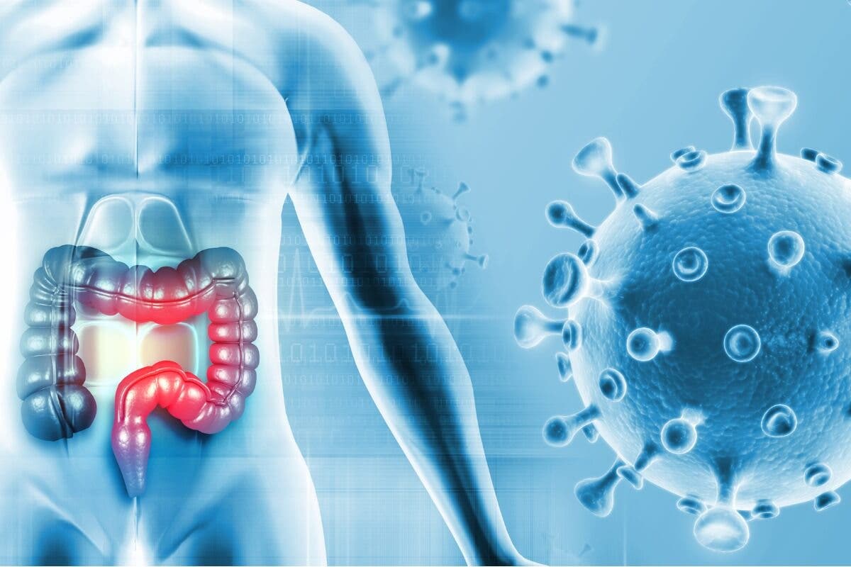 Nuevo estudio identifica una bacteria de la boca que puede promover el cáncer de colon.