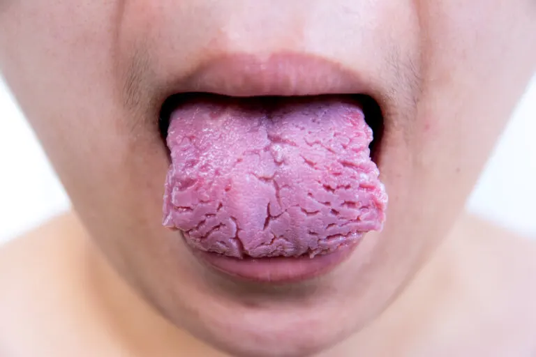 Lengua agrietada o fisurada: causas y tratamiento