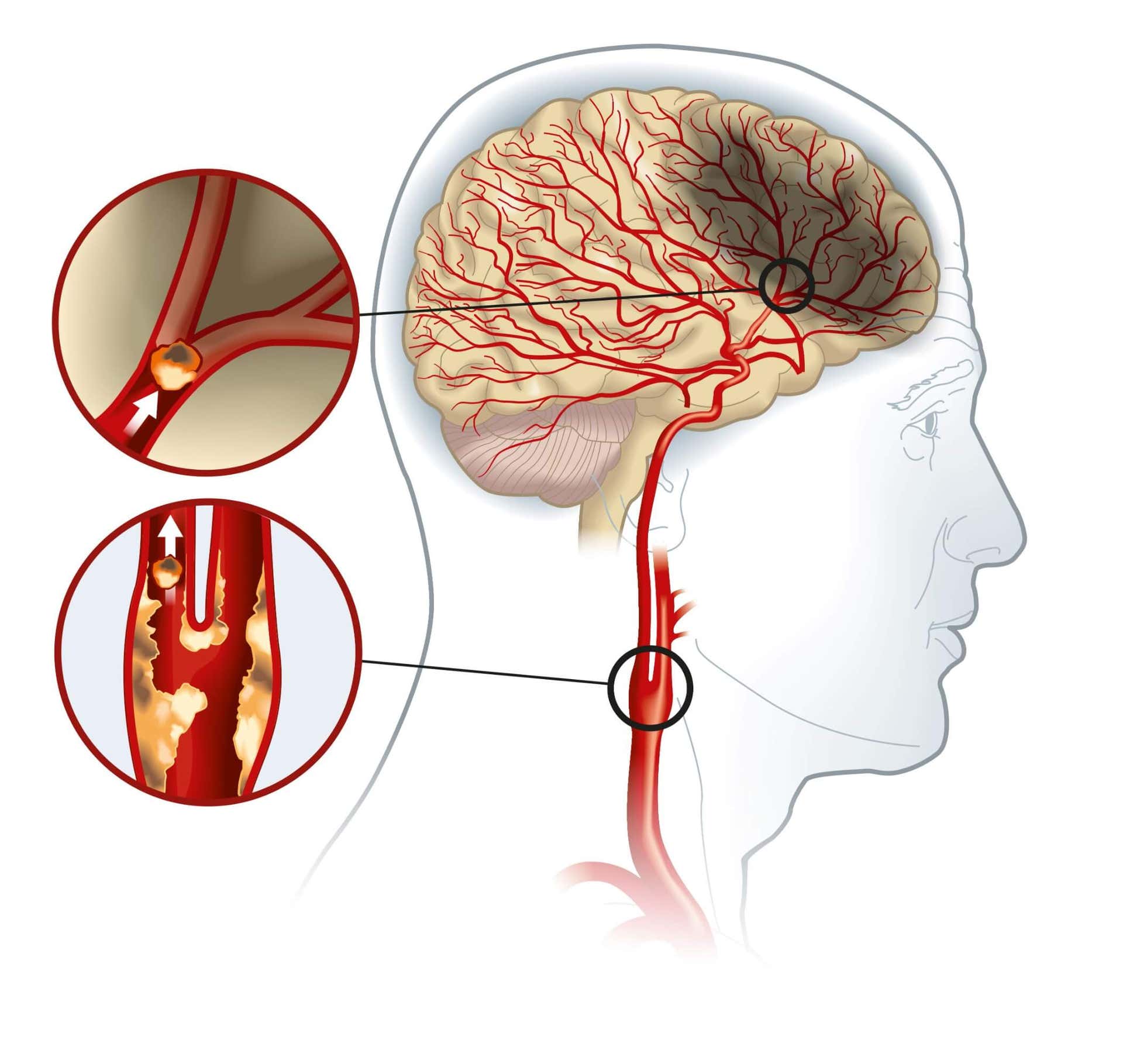 Maladie de l'artère carotide : causes et traitements possibles