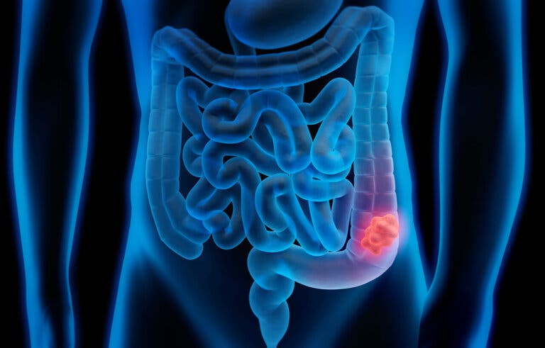 Científicos españoles descubren las células que causan la recaída en el cáncer de colon
