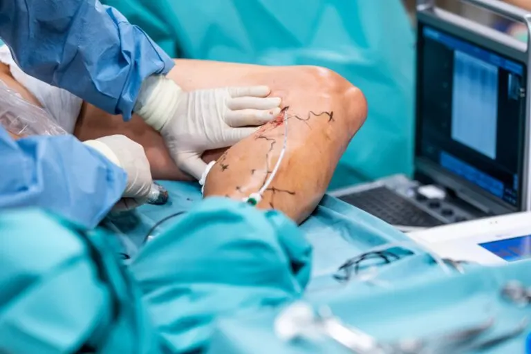 Cirugía endoláser para las varices: en qué consiste y cuáles son sus beneficios
