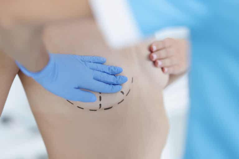 Mastopexia: beneficios y riesgos de elevar las mamas