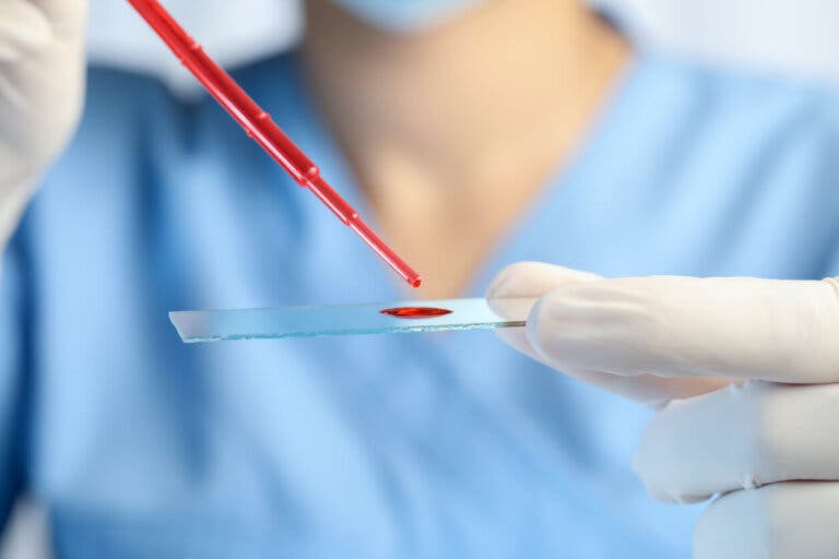 Leucemia eosinofílica crónica: síntomas, diagnóstico y tratamiento
