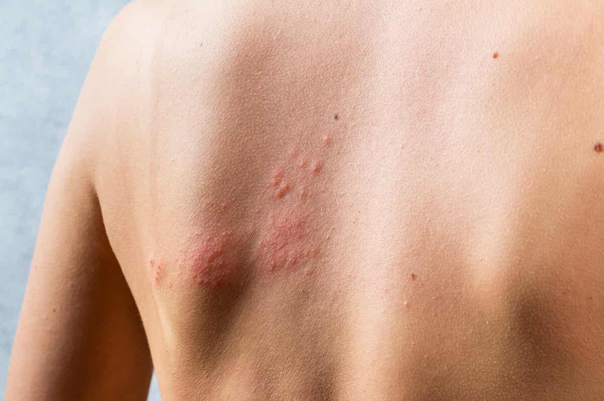 Hautreizung durch Reibung - gerötete Stellen am Rücken