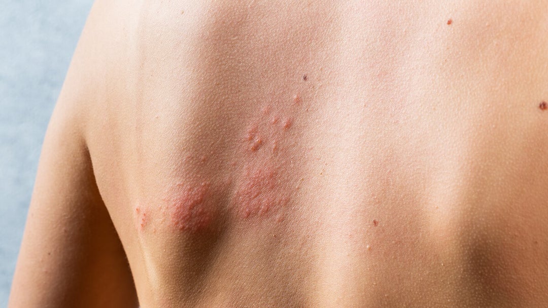 Describe Friction Rash Skin irritation due to friction: care and treatments