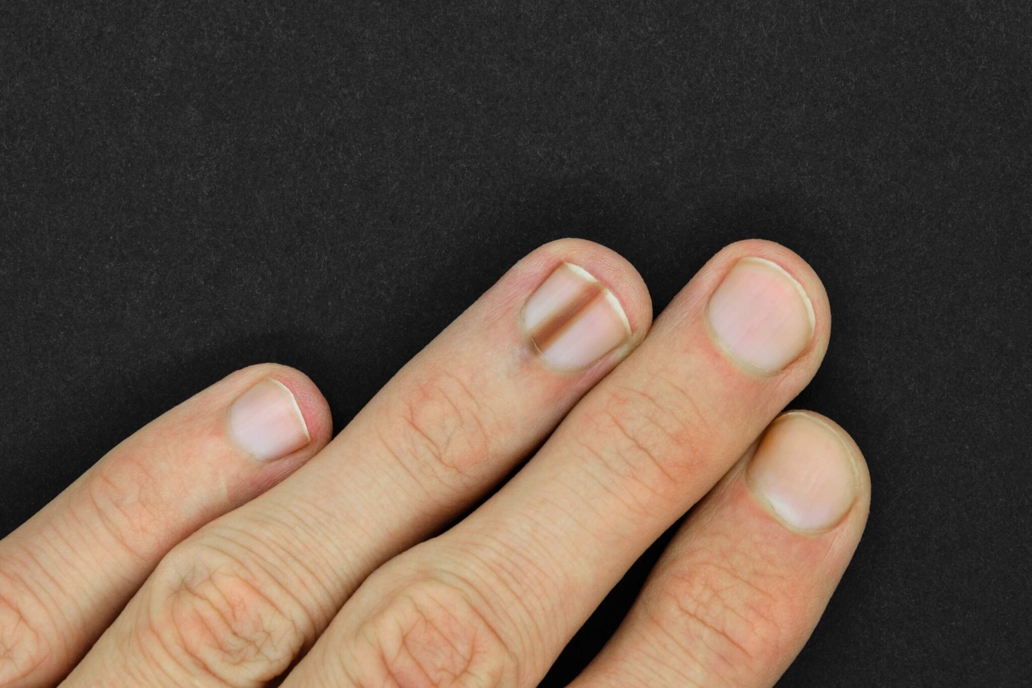 Qué son las manchas blancas que salen en las uñas  El Comercio Diario de  Asturias