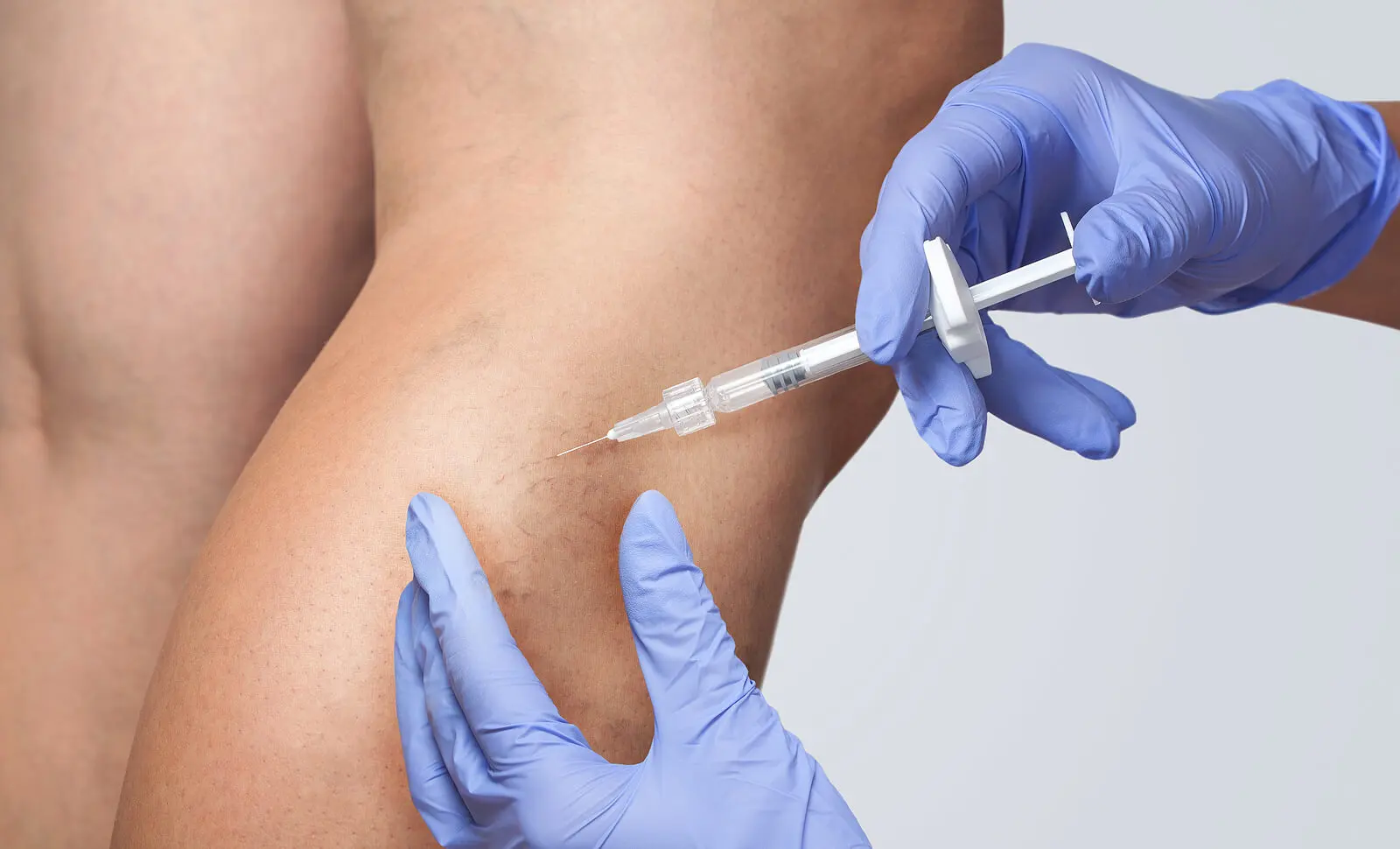 O que é a escleroterapia de varizes e por que é feita?