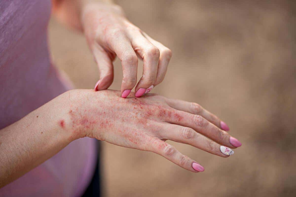 5 signos de alergia al esmalte semipermanente y cómo prevenirlos