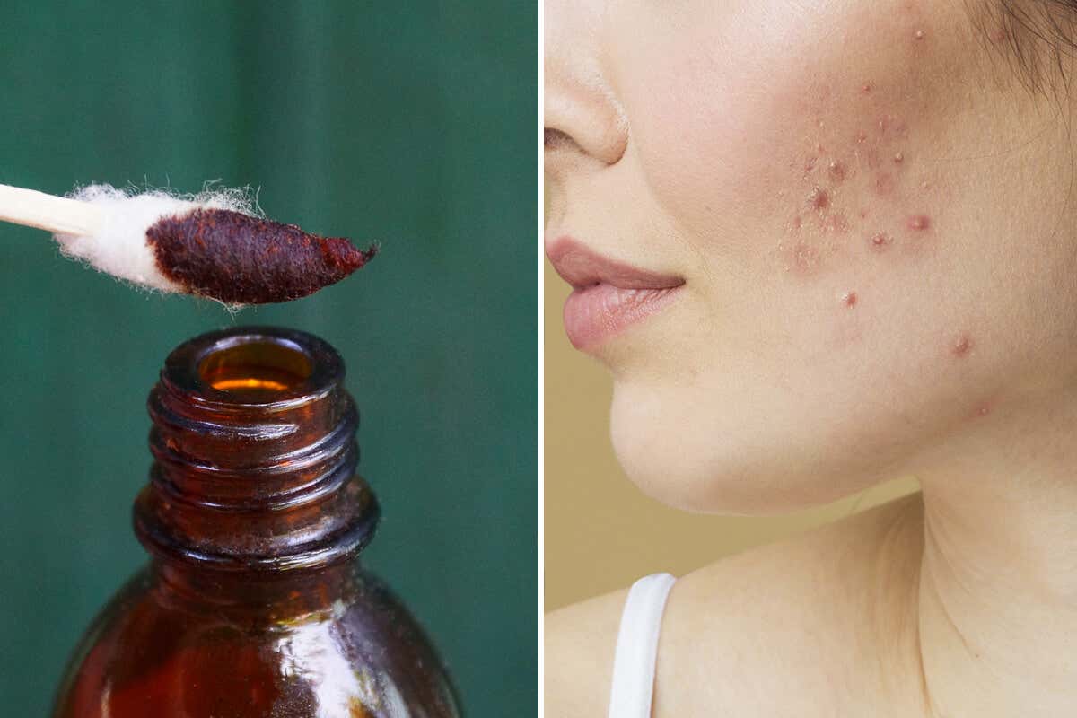 On TikTok they use iodine to get rid of acne, is this method safe?