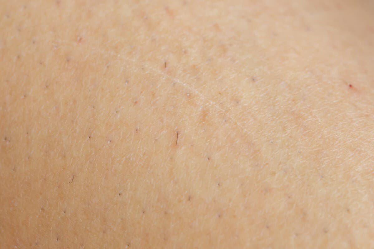 Pelo enquistado tras depilarse con cera caliente.