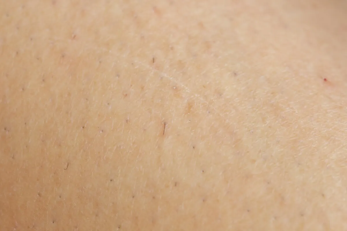 Pelo enquistado tras depilarse con cera caliente.