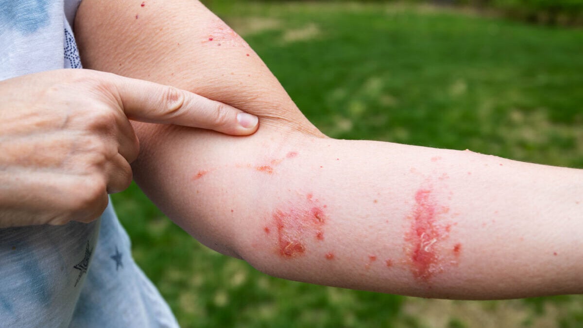 How to recognize poison ivy and what to do if you accidentally touch it