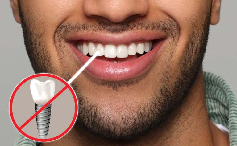 Implantes dentales sin tornillo: todo lo que necesitas saber