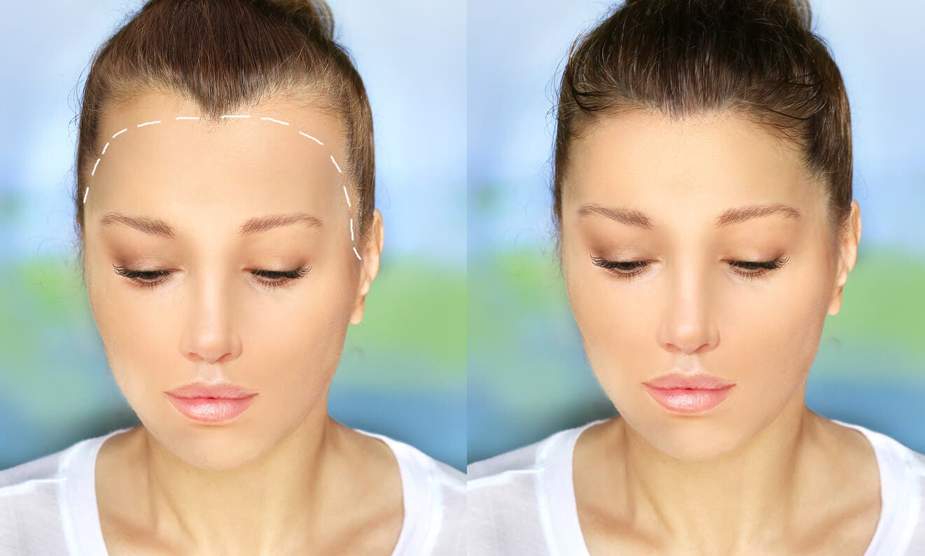 Antes y después de implante capilar en mujer.