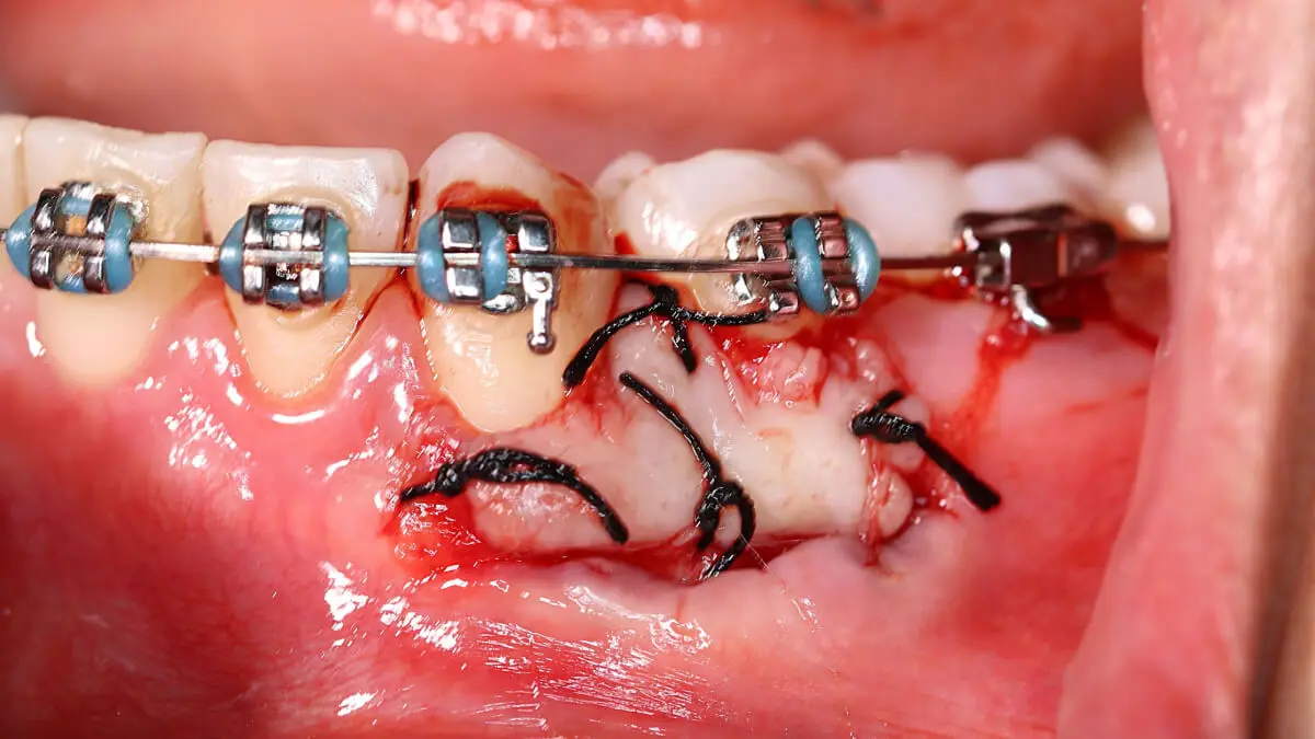 Enxerto de palato para retração gengival.