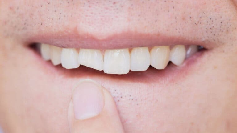 ¿Qué puedo hacer para arreglar un diente roto?