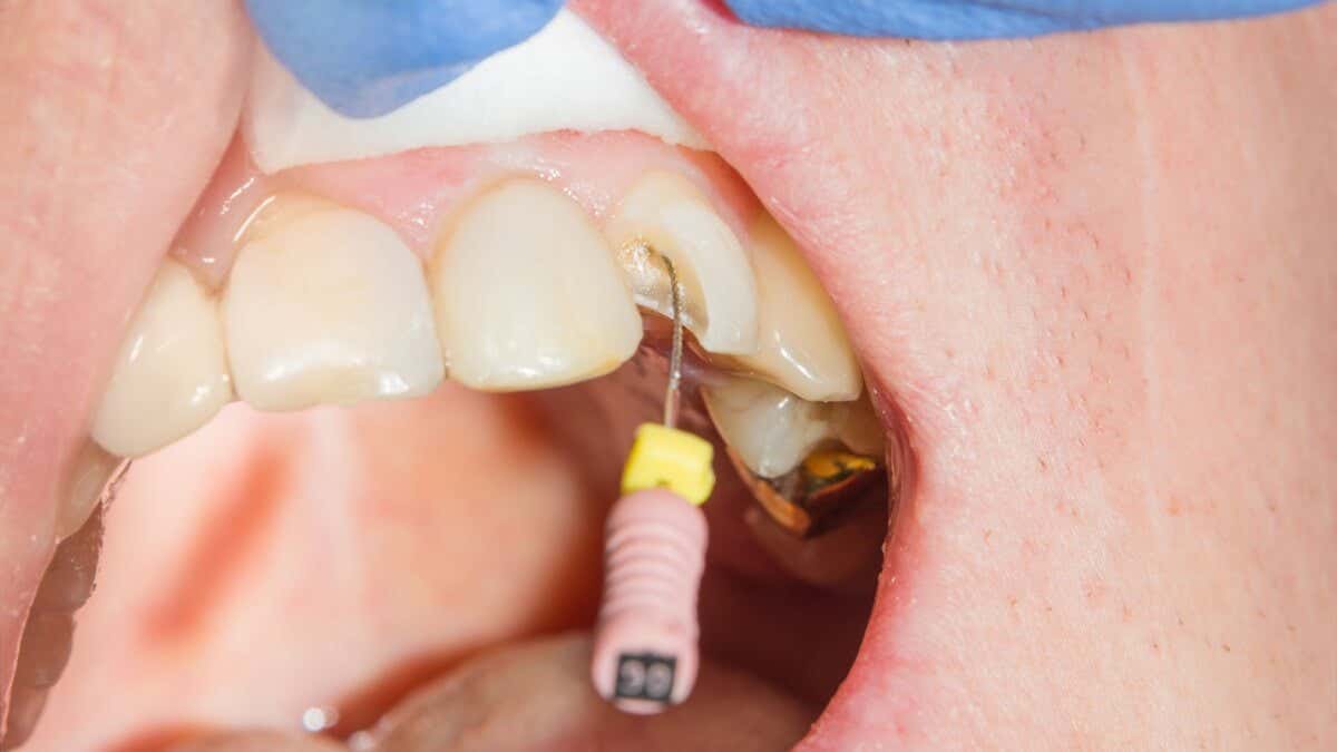 Endodoncia en un diente roto.
