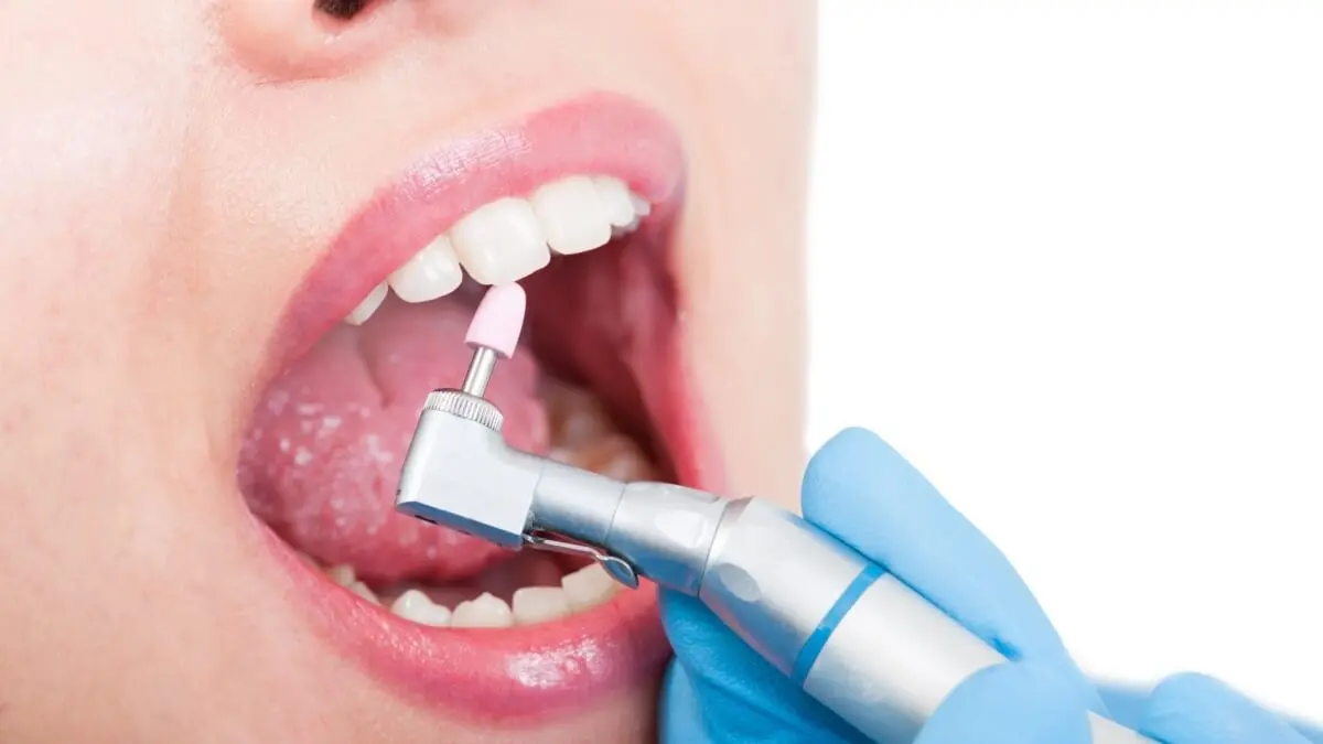 Pulido en un diente roto.