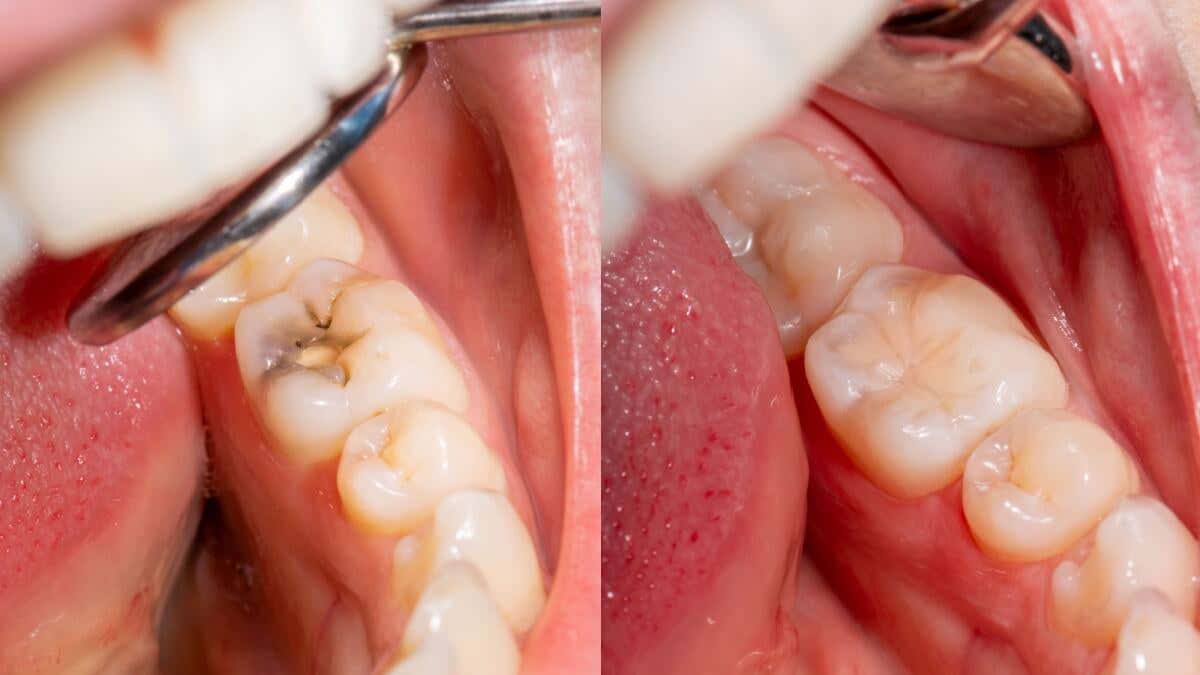Sellador dental por diente roto.