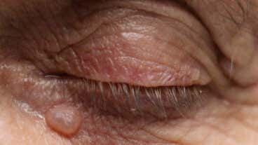 Verrugas en los párpados: por qué se forman y cómo se pueden eliminar