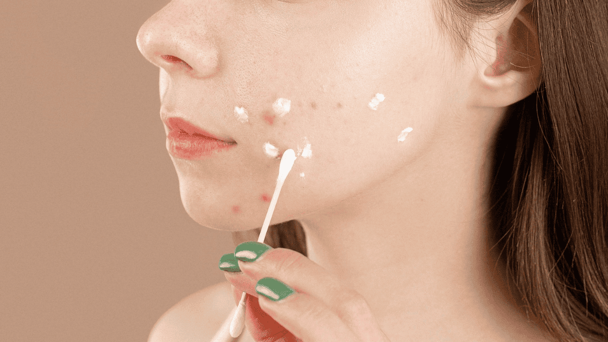 Application de crème sur un bouton