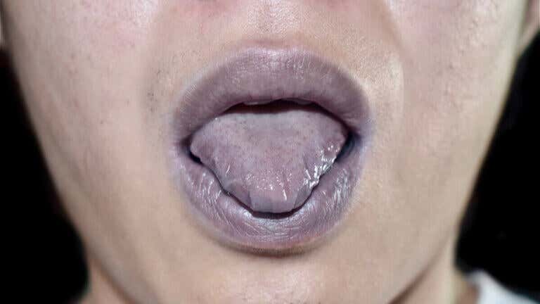 ¿Por qué se ponen los labios morados? 17 causas