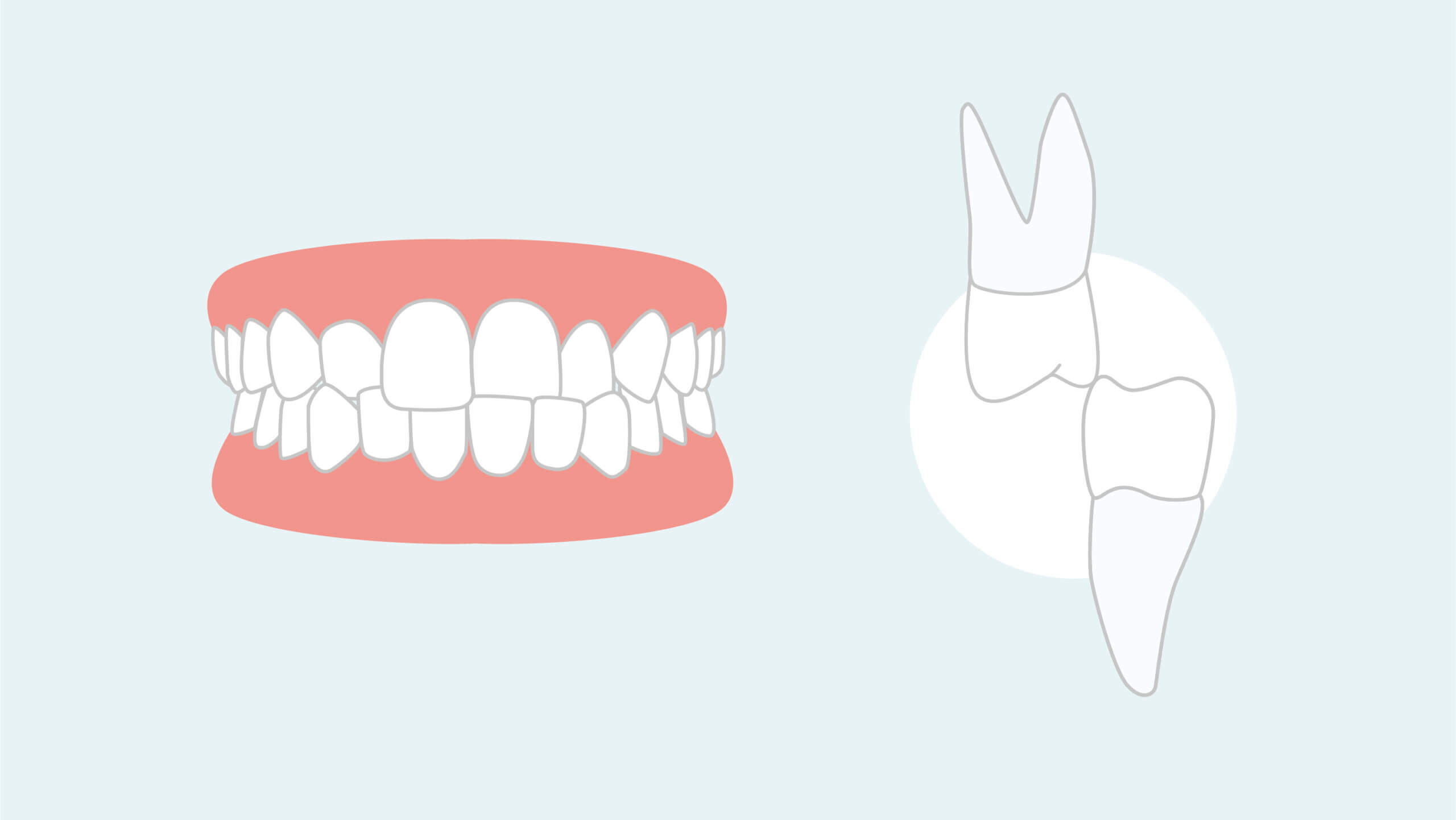 Diagramme d'occlusion croisée.