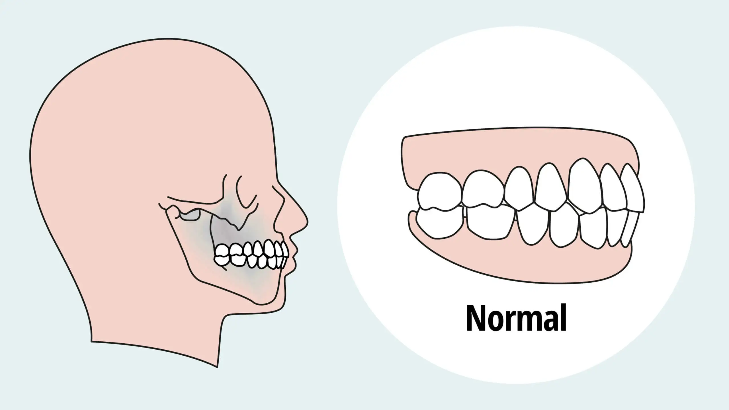 Morsure avec occlusion normale.