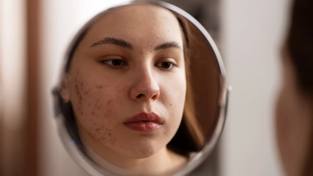 Joven mujer con acné.