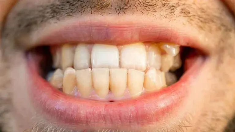 ¿Qué es la mordida cruzada? Causas y tratamientos