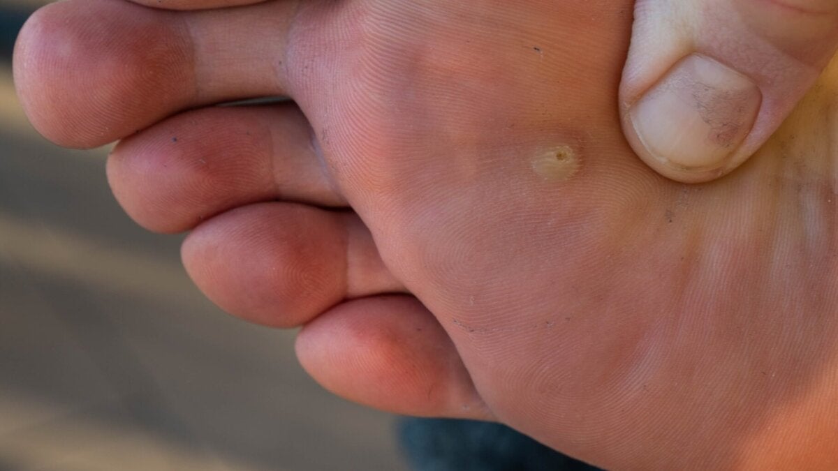 Ojo de pescado en el pie: ¿por qué sale y cómo tratarlo?