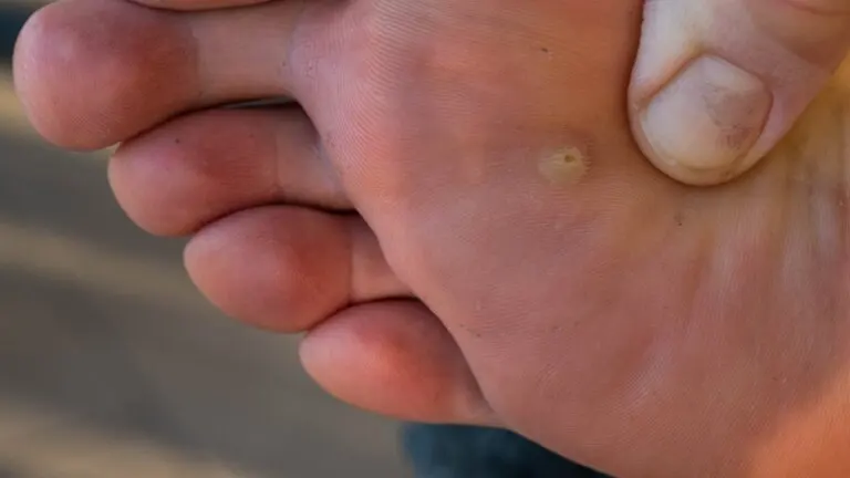 Ojo de pescado en el pie: síntomas, contagio y prevención