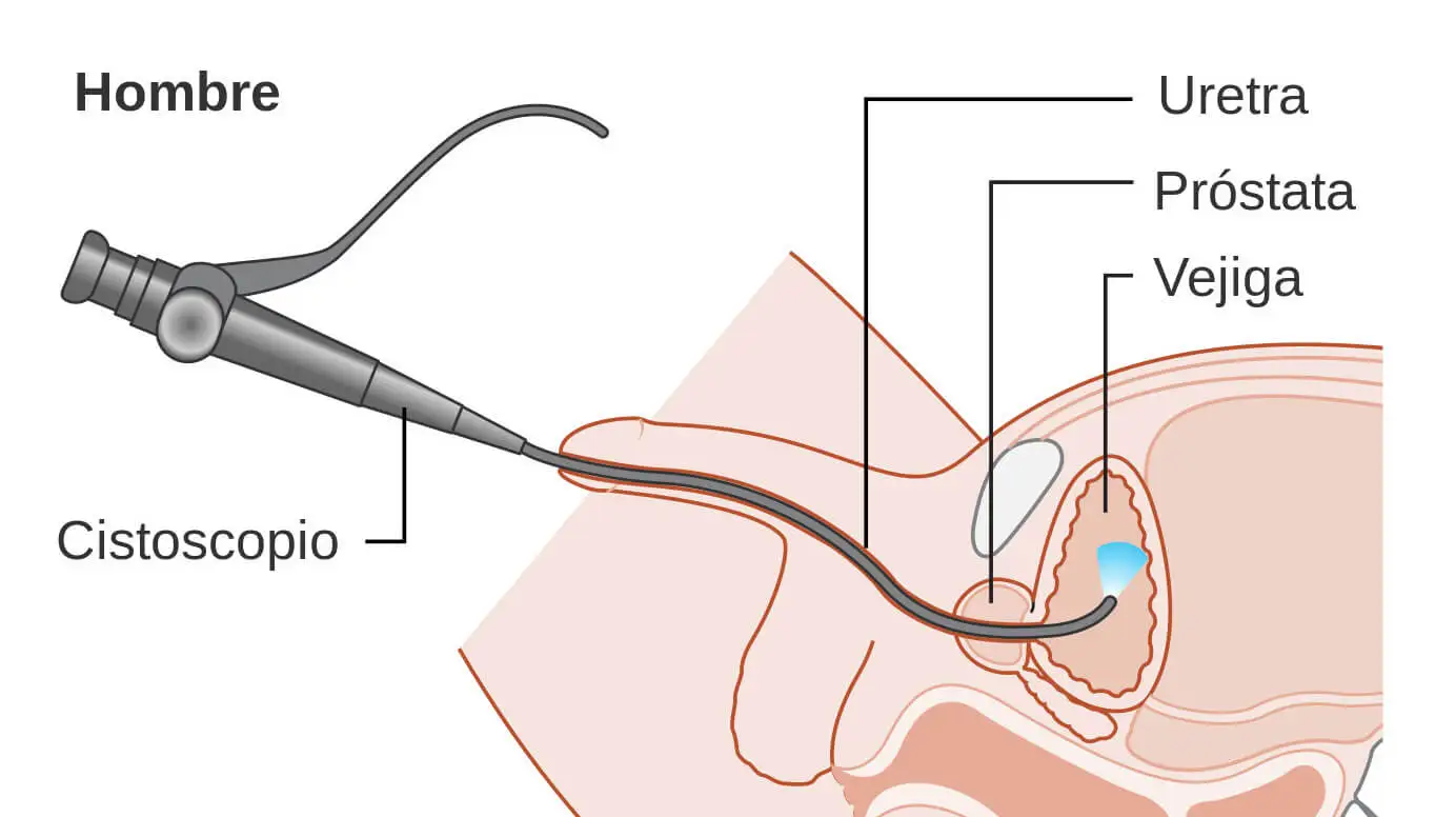 Cistoscopia en varones sin dolor.