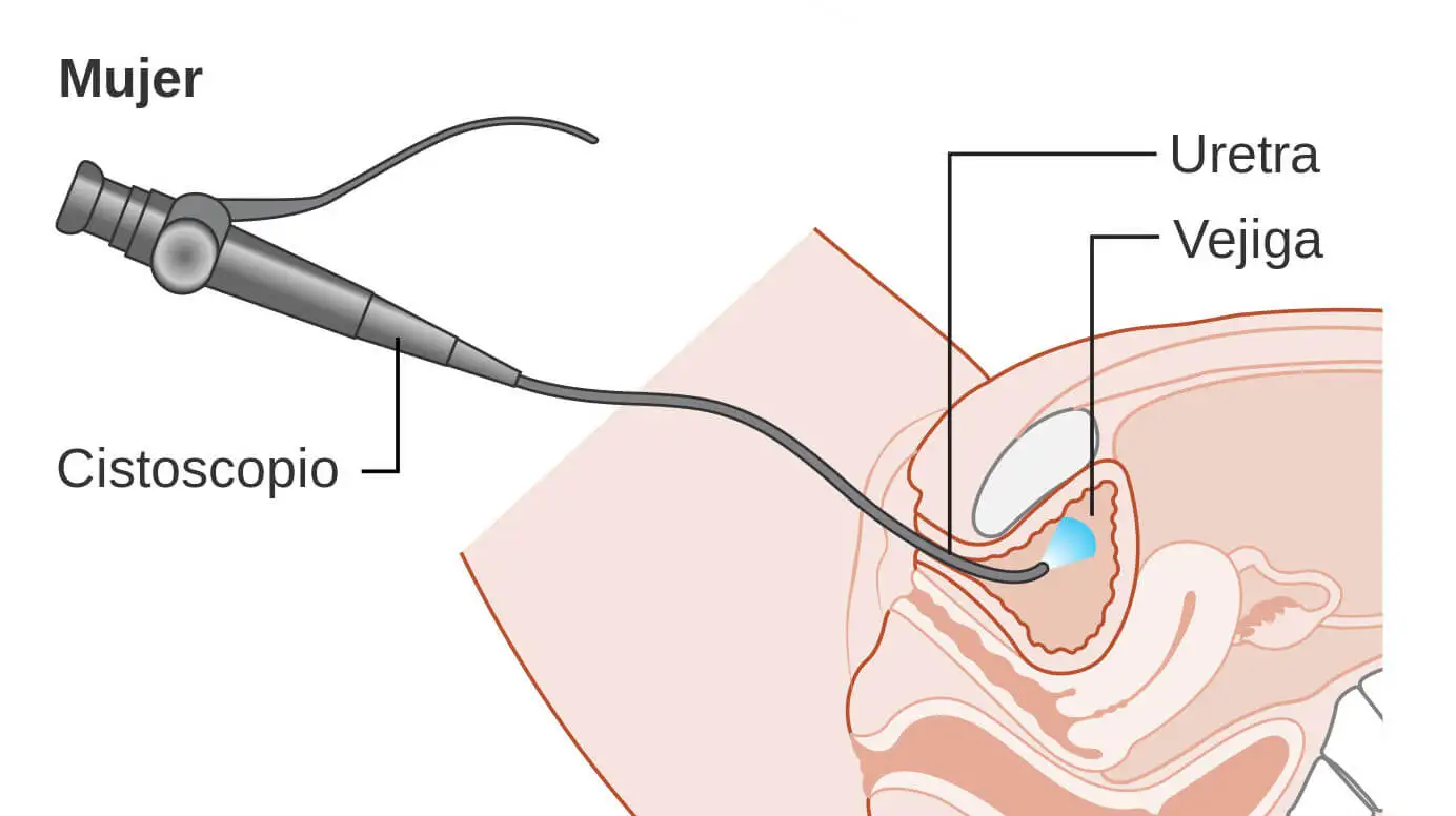 Esquema de cistoscopia en mujeres.
