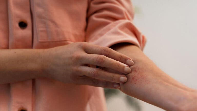 Aprende a identificar 15 tipos de picaduras de insectos