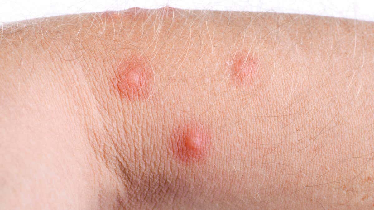 Aprende A Identificar 15 Tipos De Picaduras De Insectos Mejor Con Salud aprende-a-identificar-15-tipos-de-picaduras-de-insectos-mejor-con-salud
