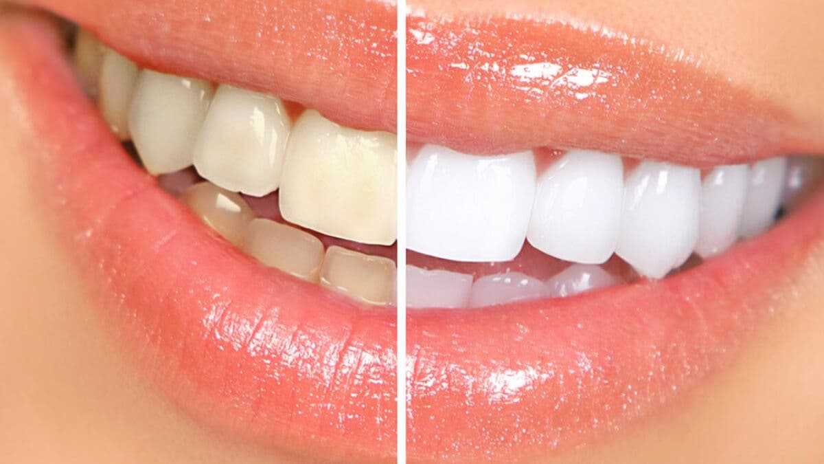 Blanqueamiento de dientes
